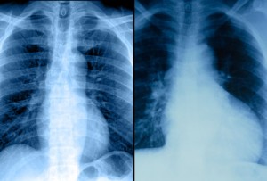 Competition for Intrathoracic Space Reduces Lung Capacity in Patients With Chronic Heart Failure: Results
