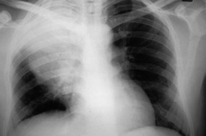 Resource Utilization of Adults Admitted to a Large Urban Hospital With Community-Acquired Pneumonia Caused by Streptococcus pneumoniae: Discussion